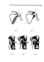 Способ лечения переднего вывиха плеча у больных с парезом эрба (патент 2626197)