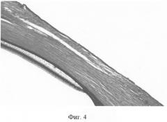 Способ укрепления склеры (патент 2265441)