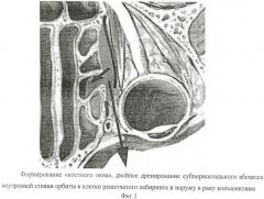 Способ хирургического лечения субпериостального абсцесса внутренней стенки орбиты (патент 2458660)