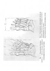 Способ лечения поперечной распластанности стопы (патент 2637603)