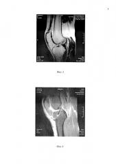 Способ двухпучковой реконструктивной пластики передней крестообразной связки коленного сустава у пациентов с фронтальной нестабильностью коленного сустава (патент 2621594)