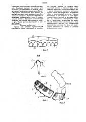 Протез для лечения патологической стираемости зубов (патент 1595500)