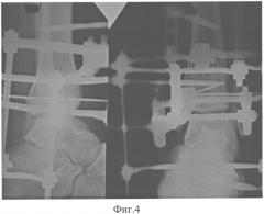 Способ лечения сложных пронационно-эверсионных переломов дистального суставного отдела костей голени (патент 2551303)