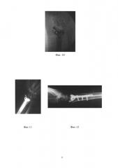 Способ артропластики дистального отдела лучевой кости при многооскольчатых внутрисуставных переломах дистального отдела лучевой кости (патент 2641379)