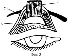Способ хирургического лечения птоза верхнего века тяжелой степени (патент 2392908)