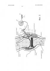 Динамическое хирургическое измерение потока (патент 2607340)