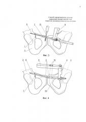 Способ хирургического лечения переломов лонных костей таза закрытым внутрикостным остеосинтезом (патент 2661714)