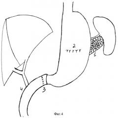 Способ панкреатогастроанастомоза при привратникосохраняющей панкреатодуоденальной резекции (патент 2254816)