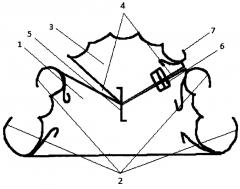 Ортодонтическое устройство для выравнивания центра зубного ряда верхней челюсти (патент 2637919)