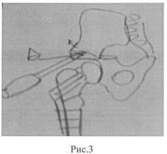 Способ остеотомии таза при лечении дисплазии вертлужной впадины (патент 2527161)