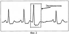 Способ обработки электрокардиосигнала (патент 2481060)