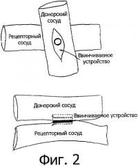 Ввинчиваемое устройство для анастомоза (патент 2329774)