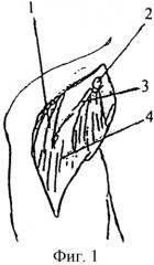 Способ лечения привычного вывиха плеча (патент 2557704)