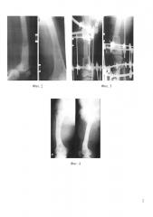 Способ сращения отломков диафизарной области длинной трубчатой кости при остеомиелитическом поражении (патент 2604769)