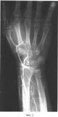 Способ лечения несросшихся переломов и ложных суставов ладьевидной кости запястья (патент 2277879)