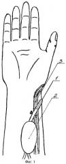 Способ пластики дефекта мягких тканей кисти и пальцев (патент 2393781)