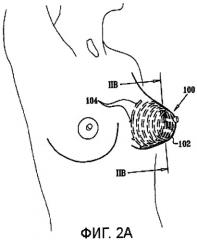 Имплантируемый экспандер тканей человека (патент 2405501)