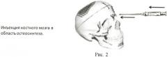 Способ ускорения регенерации костной ткани при проведении остеосинтеза (патент 2410050)