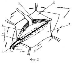Способ безнатяжной комбинированной пластики пахового канала по кошеву-петрову (патент 2262312)