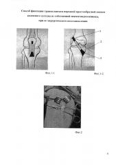 Способ фиксации трансплантата передней крестообразной связки коленного сустава из собственной связки надколенника, при её хирургическом восстановлении (патент 2597992)