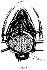 Способ хирургической реконструкции пузырно-влагалищной перегородки при опущении и выпадении передней стенки влагалища и цистоцеле (патент 2262314)
