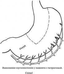 Способ удлинения желудочного трансплантата (патент 2454949)