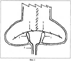 Способ формирования ортотопического мочевого резервуара (патент 2264790)