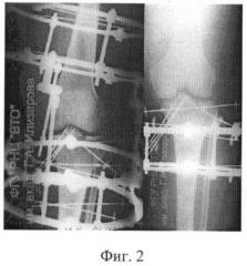 Способ лечения перелома межмыщелкового возвышения большеберцовой кости (патент 2391066)