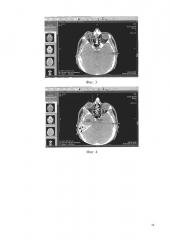Способ пошаговой компьютерной экзофтальмометрии (патент 2622978)