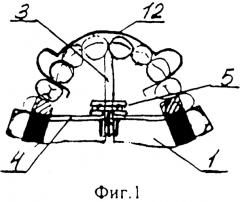 Аппарат для лечения гнатической формы дистальной окклюзии у подростков (патент 2587303)