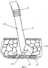 Способ оперативного лечения нагноившегося эпителиального копчикового хода на стадии абсцесса (патент 2319455)