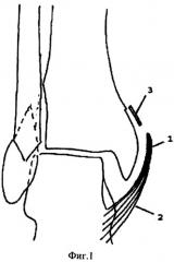 Способ оперативного лечения застарелых повреждений голеностопного сустава (патент 2283048)