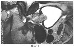Способ диагностики гиперактивного мочевого пузыря у пациентов с аденомой предстательной железы (патент 2567607)