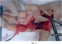 Способ лечения тяжелой формы контрактуры дюпюитрена пальцев кисти (патент 2421168)