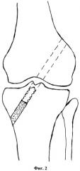 Способ пластики передней крестообразной связки коленного сустава (патент 2545425)