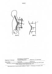 Способ лечения кифотической деформации позвоночника и устройство для его осуществления (патент 1662522)