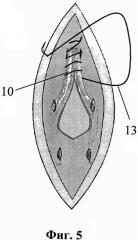 Способ операции при срединных вентральных грыжах (патент 2614938)