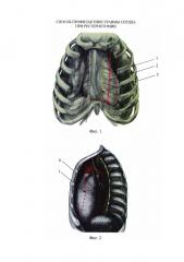 Способ профилактики травмы сердца при рестернотомии (патент 2613079)