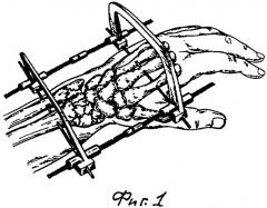 Устройство для дистракционного остеосинтеза лучезапястного сустава (патент 2299034)