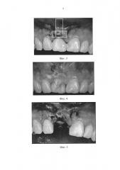 Способ непосредственной дентальной имплантации (патент 2636893)