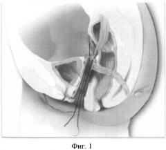 Способ хирургического лечения опущения передней стенки влагалища у женщин с высоким риском рецидива после экстирпации матки (патент 2499570)