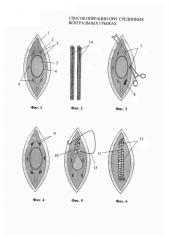 Способ операции при срединных вентральных грыжах (патент 2614938)