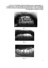 Способ лечения гипертрофического гингивита у пациентов с несъемной ортодонтической техникой с применением инъекционной формы аутологичной тромбоцитарной плазмы (патент 2626826)