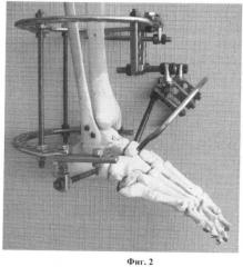 Способ трехсуставного артродеза стопы (патент 2467718)