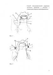 Способ гемодинамической коррекции легочного кровотока у больных с унивентрикулярным кровообращением (патент 2601107)