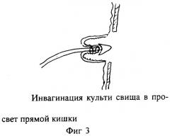 Способ хирургической коррекции сложных параректальных свищей (патент 2290881)