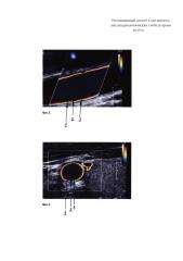 Неинвазивный способ комплексного анализа реологических свойств крови in vivo (патент 2625281)