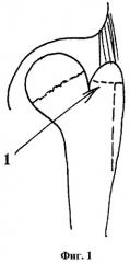 Способ сохранения скользящей функции отводящих мышц бедра при низведении большого вертела (патент 2306885)