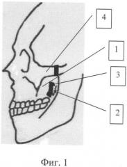 Способ лечения верхней микроретрогнатии у детей и устройство для его осуществления (патент 2332955)
