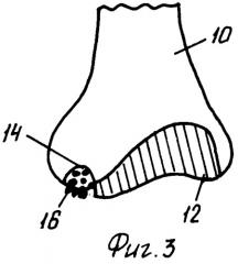 Костный материал и коллагеновая композиция для восстановления поврежденных суставов (патент 2292858)